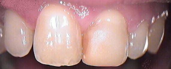before treatment