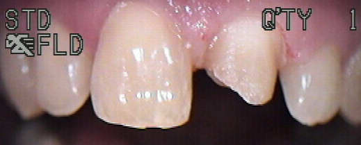 tooth drilled