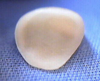 crown bottom view front tooth