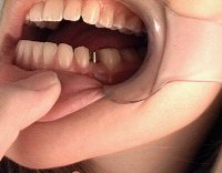 implant abutment